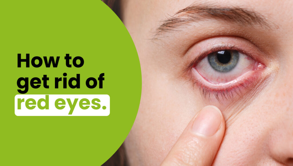 How to Get Rid of Red Eyes