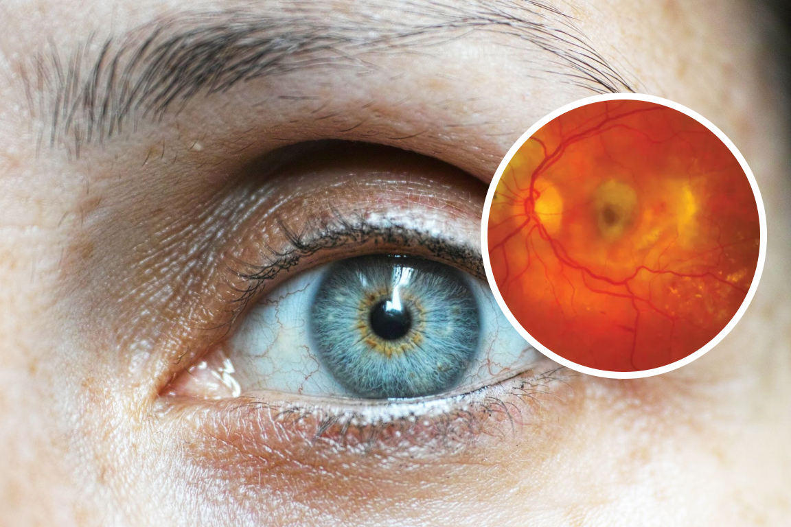 What Is Macular Degeneration?